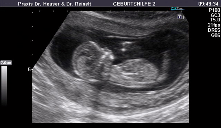 Ultraschall in der 13. Schwangerschaftswoche