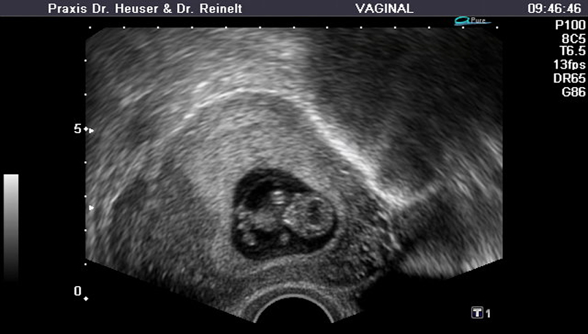 Sonographie in der 10. Schwangerschaftswoche